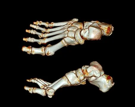 Computed Tomography of the Foot Stock Illustration