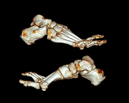 Computed Tomography of the Foot Stock Illustration