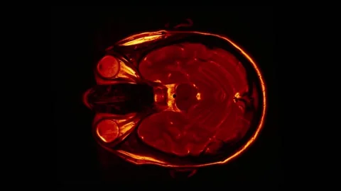 Computed tomography of the human brain Stock Footage 151411374