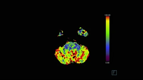 Computed Tomography of the  human brain perfusion study Stock Footage
