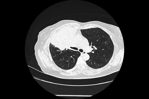 Computed tomography image of a patient with a lung tumor. Stock-Fotos