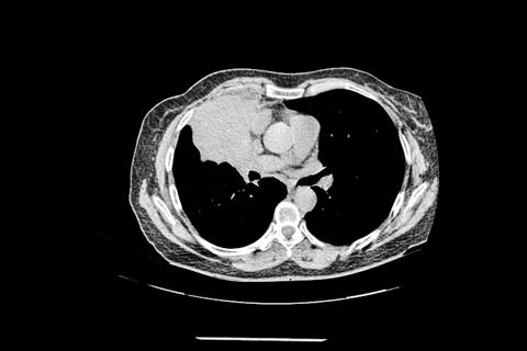 Computed tomography image of a patient with a lung tumor. Stock-Fotos