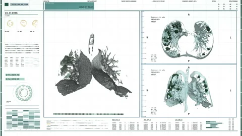 Computed tomography of the lungs damage by Covid 19. 3D scan modern tomography. Stock Footage 145586003