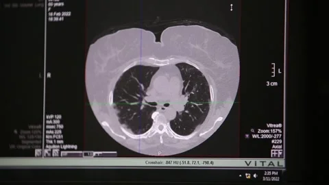 Computed Tomography scan 8 Video stock 317081228