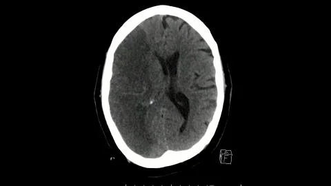 Computed tomography scan of the brain axial cut showing  infarction Stock Illustration
