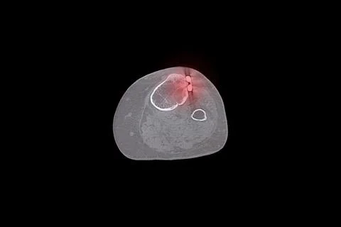 Computed tomography scan of a leg after a fracture and surgical treatment w.. Stock Photos