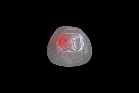 Computed tomography scan of a leg after a fracture and surgical treatment w.. Stock Photos