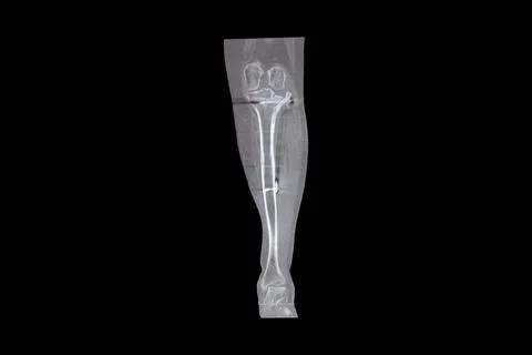 Computed tomography scan of a leg after a fracture and surgical treatment w.. Stock Photos