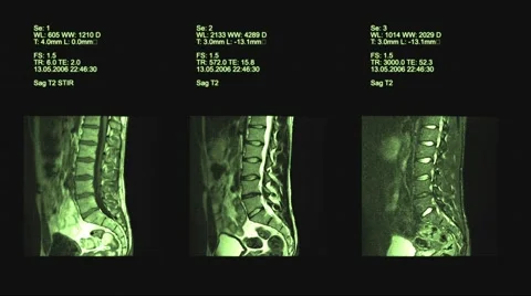 Computed tomography of the spine. Stock Footage 63434195