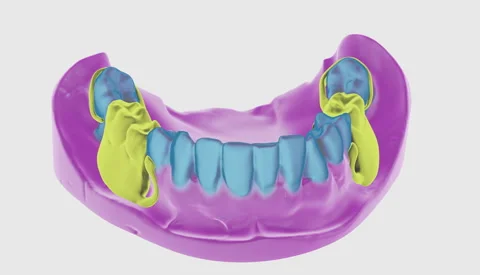 Computer 3D visualisation of the artificial dental replacement treatment Stock Footage 319673192