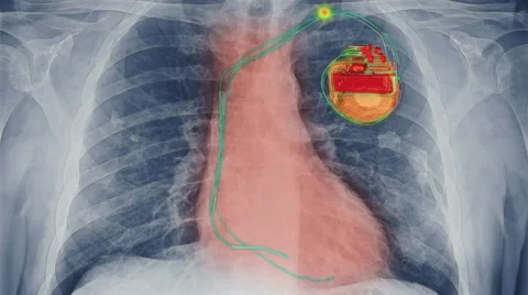 Computer animation of pacemaker firing Stock Footage 62463029