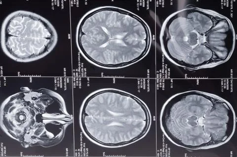 Computer axial tomography scan (cat) of a head Stock Photos