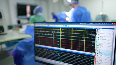 Computer screen with running curved lines. Medical team works at operation in Stock Footage 331081520