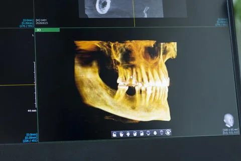 Computer Screen Showing 3D Color Volumetric Dental Scan of Jawbone and Teet.. 스톡 사진