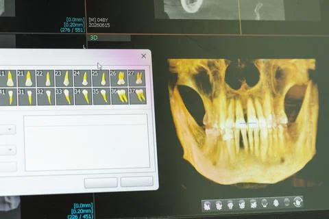 Computer Screen Showing 3D Dental CBCT Software with Volumetric Skull Rende.. 스톡 사진