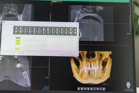 Computer Screen Showing 3D Dental CBCT Software with Volumetric Skull Rende.. 스톡 사진