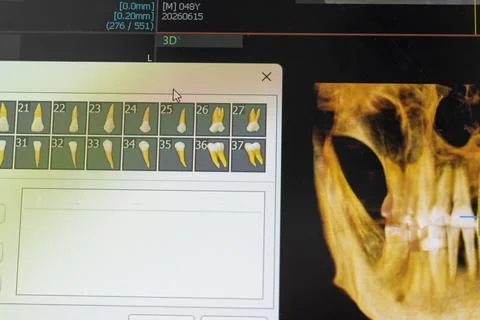 Computer Screen Showing 3D Dental CBCT Software with Volumetric Skull Rende.. 스톡 사진