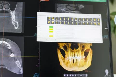 Computer Screen Showing 3D Dental CBCT Software with Volumetric Skull Rende.. 스톡 사진
