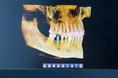 Computer Screen Showing 3D Dental CBCT Scan with Simulated Tooth Implant Pl.. Stock Photos