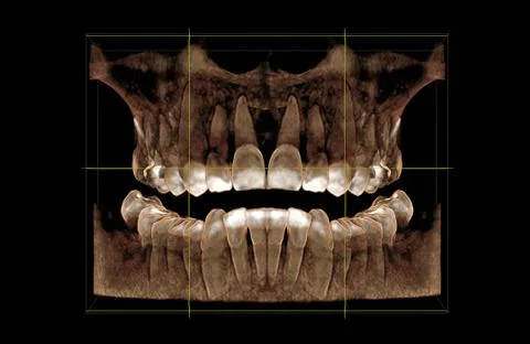 Computer tomogram of the dentition Stock-Fotos