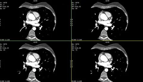 Computerized tomography CT coronary angiogram. Axial contrast of the cardio Foto stock