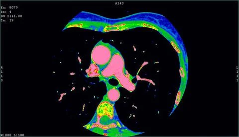 Computerized tomography CT coronary angiogram. Axial contrast of the cardio Foto stock