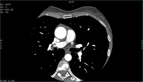 Computerized tomography CT coronary angiogram. Axial contrast of the cardiac Foto stock