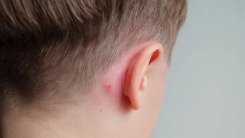 Concept of allergic reaction by mosquito bites. Ear close-up. Head of child with Stock Footage 268855416