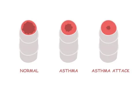 The concept of an attack of asthma. Illustration of bronchi. イラスト素材