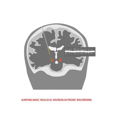 Concept of brain recording in subthalamic nucleus for Parkinson disease surge Illustrazione stock