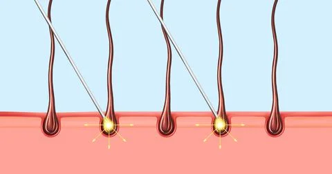 The concept of hair restoration by injection methods. Mesotherapy, botox, ozone Stock Illustration