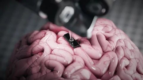 The concept of implanting a chip into the human brain with the help of a ro.. 스톡 동영상 267071577
