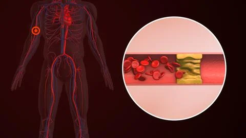 Concept of peripheral pain in human hand Stock Illustration