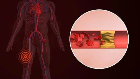 Concept of peripheral pain in human thigh Stock Illustration
