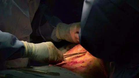 Concept of plastic surgery, implants, cosmetic surgery. Stock Footage 270469628