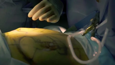Concept of plastic surgery, implants, cosmetic surgery. Stock Footage 270474329