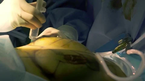 Concept of plastic surgery, implants, cosmetic surgery. Stock Footage 270474428