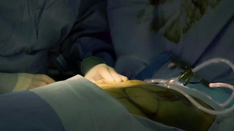 Concept of plastic surgery, implants, cosmetic surgery. Stock Footage 270474429