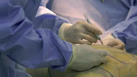 Concept of plastic surgery, implants, cosmetic surgery. Stock Footage 270482954