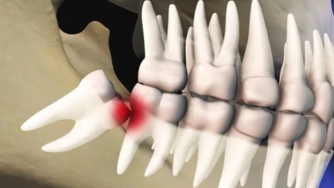 Concept of wisdom teeth pain Stock Footage 276725919