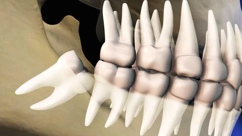 Concept of wisdom teeth pain Stock Illustration