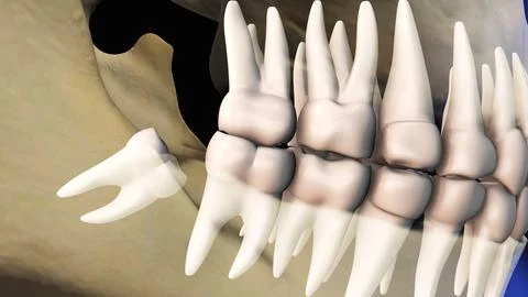 Concept of wisdom teeth pain Illustration