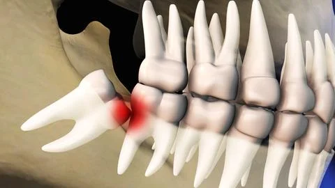 Concept of wisdom teeth pain Stock Illustration