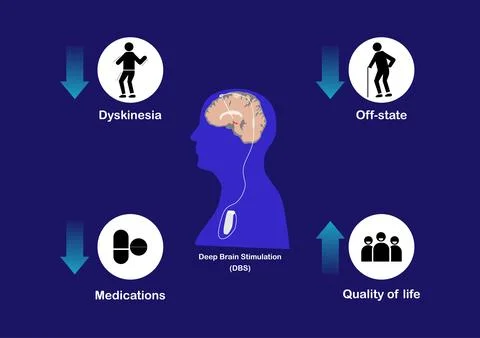 Concepts of deep brain stimulation for treatment of Parkinson's disease. Stock Illustration