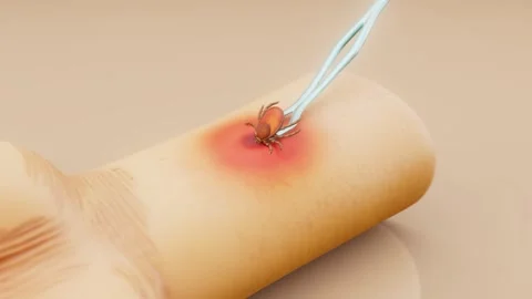 Conceptual 3D animation of the removal of a tick from human skin Stock Footage 317980028