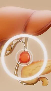 Conceptual 3D illustration of a gallbladder stone in vertical format Stock Illustration