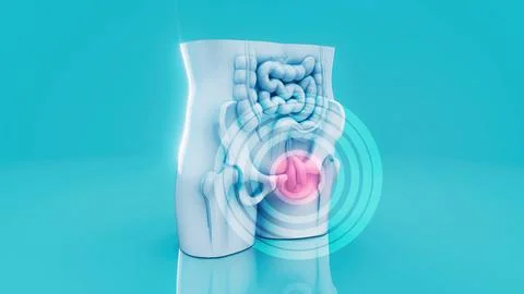 Conceptual 3D illustration of a human hernia Stock Illustration