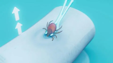 Conceptual 3D illustration of the removal of a tick from human skin Stock Illustration