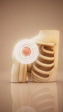 Conceptual 3D illustration of shoulder inflammation in vertical format Stock Illustration