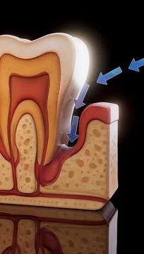 Conceptual 3D motion design illustration of periodontitis and gum inflammatio 스톡 일러스트